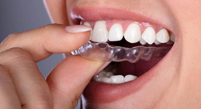 Does clear aligners treatment cause bleeding gums