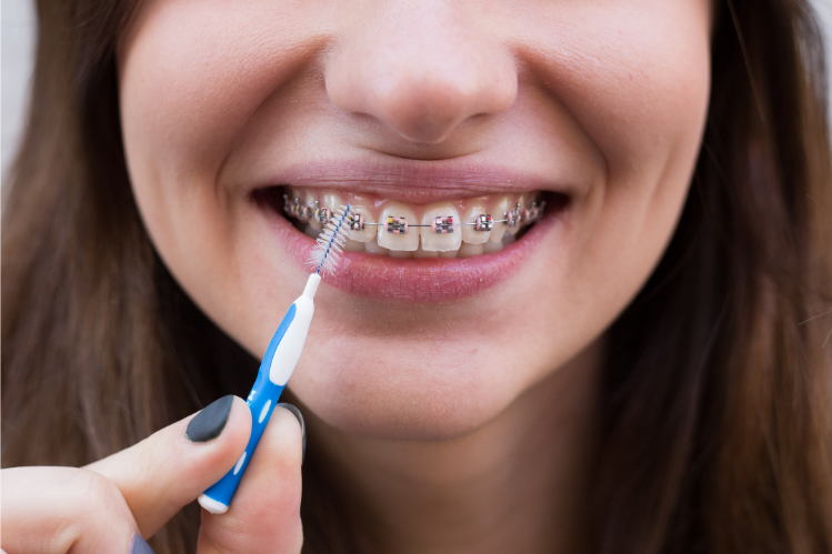A girl flossing her teeth with braces with an interdental brush 
