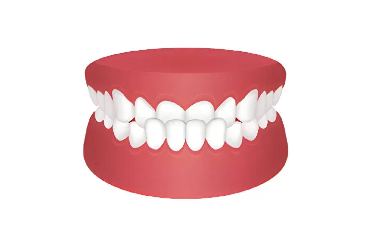 Illustration of a class 3 bite