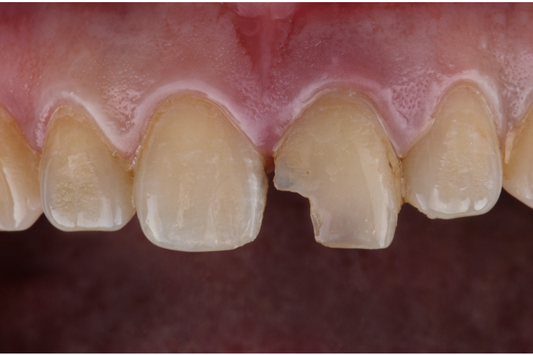A close-up of chipped front teeth