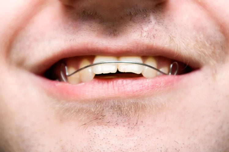 overbite