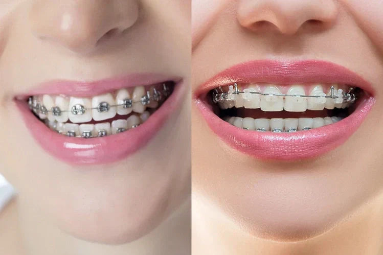 An image of two women smiling. One has metal braces on her teeth, and the other has clear braces.