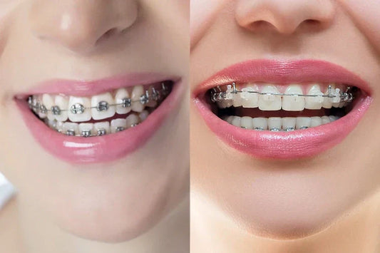 An image of two women smiling. One has metal braces on her teeth, and the other has clear braces.
