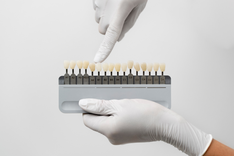 Shades of different minimal veneers