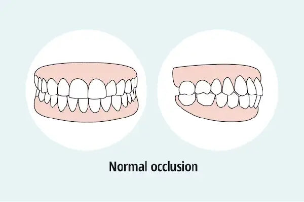An illustration of what a normal occlusion looks like