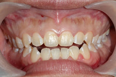 How to Fix an Open Bite: Causes, Treatments, and Clear Aligner Solutions