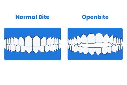 An illustration showing a normal bite and an open bite.