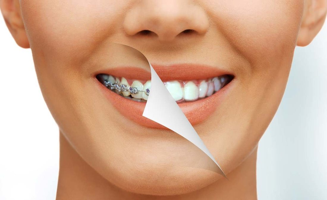 Out with metal, in with clear braces