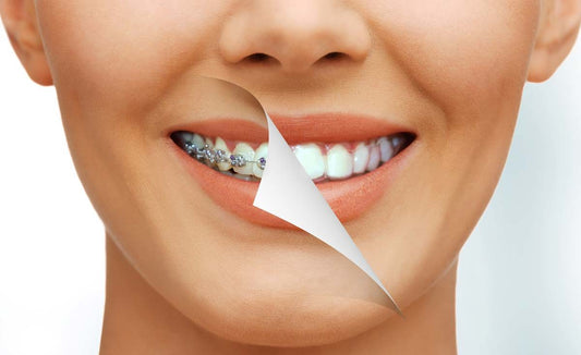 Out with metal, in with clear braces