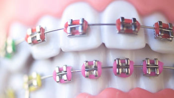 Overbite: How to Fix Without Braces