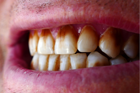 A person showing their stained teeth 