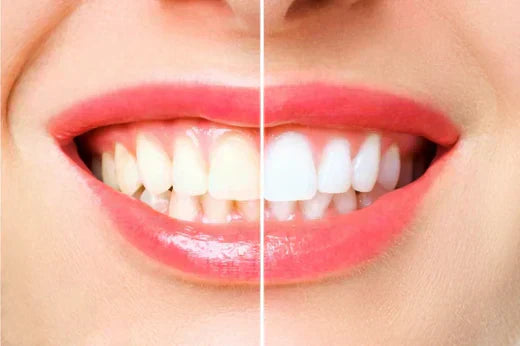 Teeth Whitening before and after 