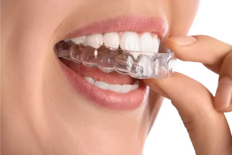 A close-up of a woman applying clear retainers