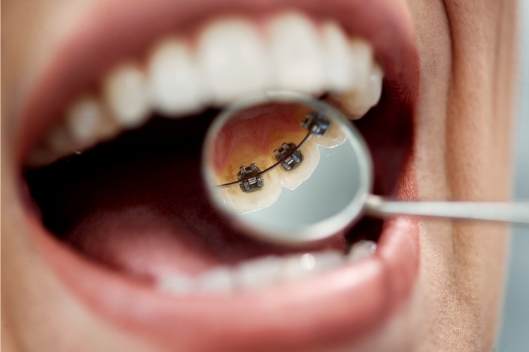 Close-up of a woman having a lingual braces check-up