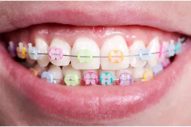 An image of ceramic orthodontic brackets