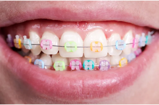 An image of ceramic orthodontic brackets
