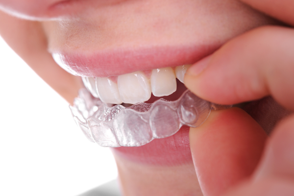 A closeup of a girl applying clear retainers
