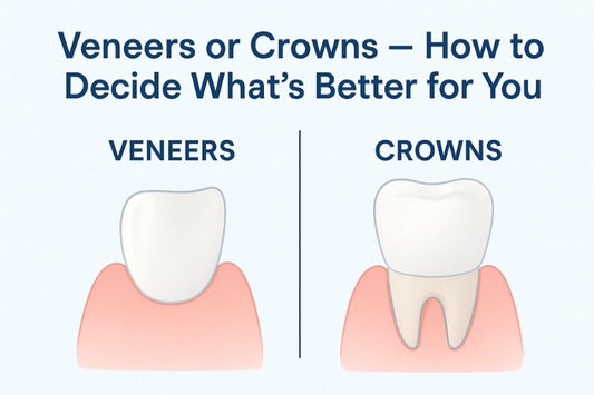 A side-by-side comparison of veneers and crowns 