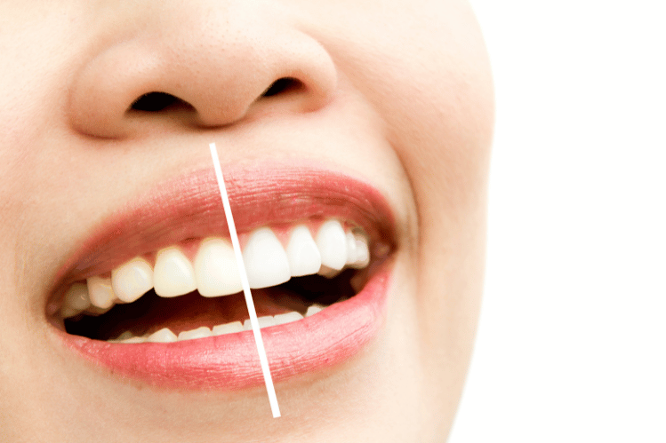  teeth whitening