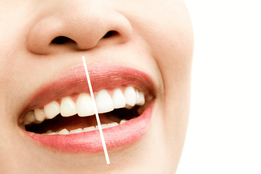  teeth whitening