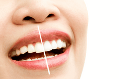 Teeth Whitening Vs Bleaching: What Is The Difference
