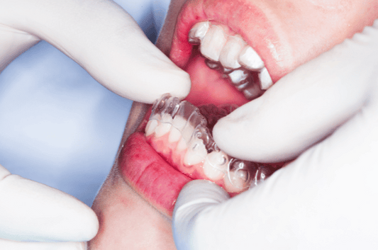 The Pros of Using Teeth Retainers