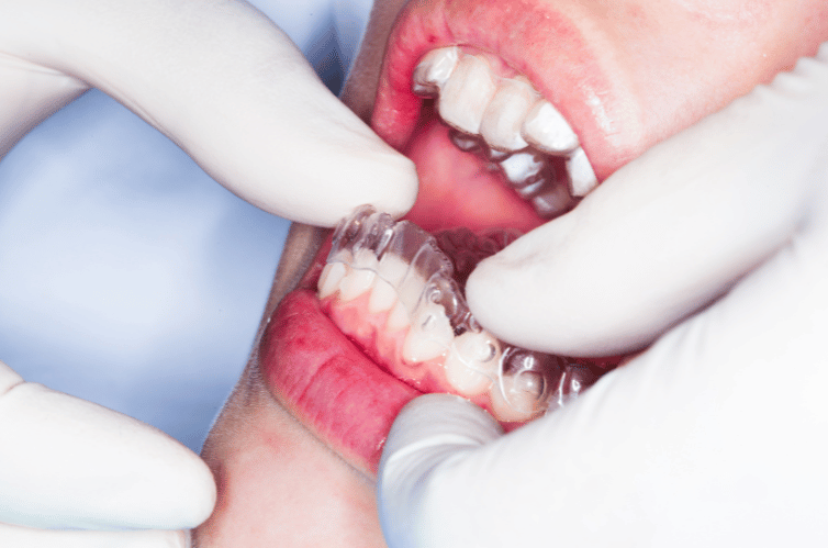 The Pros of Using Teeth Retainers