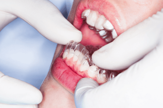 The Pros of Using Teeth Retainers