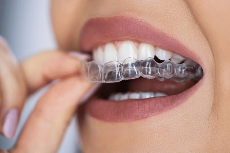 The Mental Health Benefits of Clear Aligners