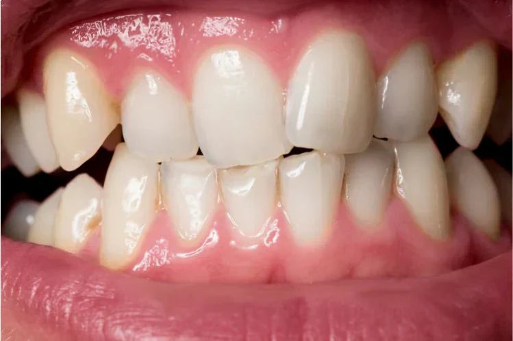 Straightening Uneven Teeth: Causes, Solutions, and How ALIGNERCO Makes It Easy
            