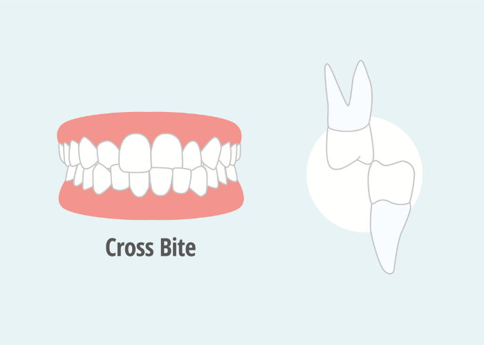 Fix crossbite with clear aligners