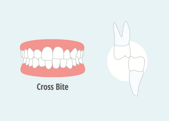 Clear Aligners for Crossbite: How They Help