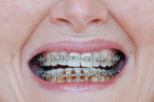  drinking alcohol with braces