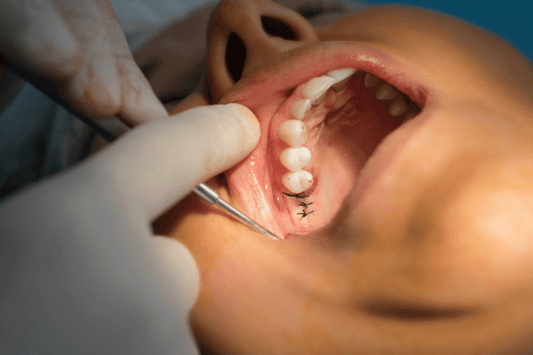 Why People Need Teeth Straightening Surgery?