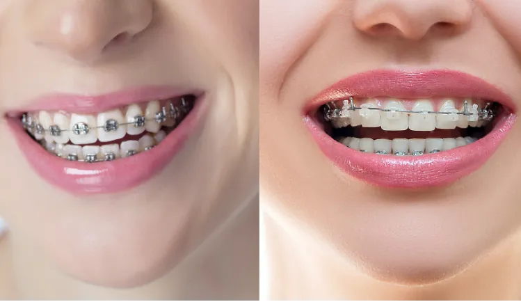 Travel Tips for Aligner Users