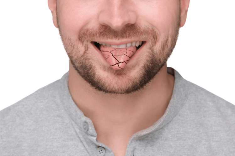 Dry Mouth and Oral Health