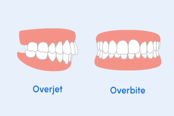  An illustration that shows the difference between an overjet and an overbite 