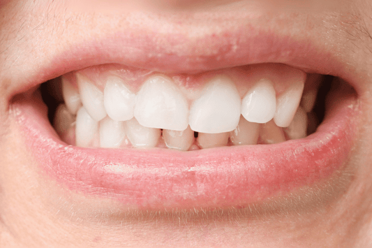 Correcting Teeth Alignment