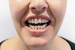 The Limitations of Crowns for Crooked Front Teeth Treatment
