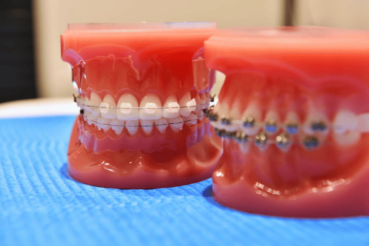  Clear Aligners vs. Braces