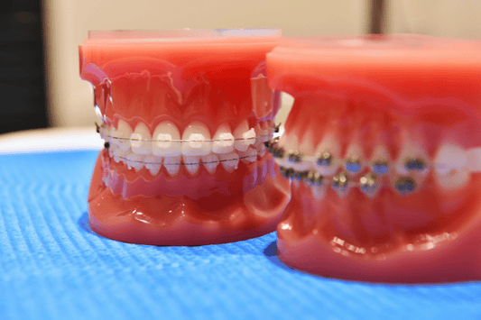  Clear Aligners vs. Braces