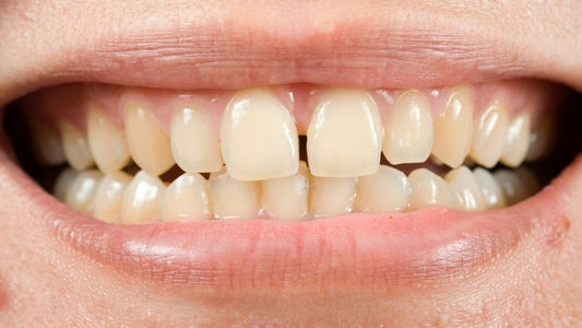teeth shifting