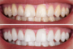 Is Teeth Polishing The Same As Teeth Whitening?