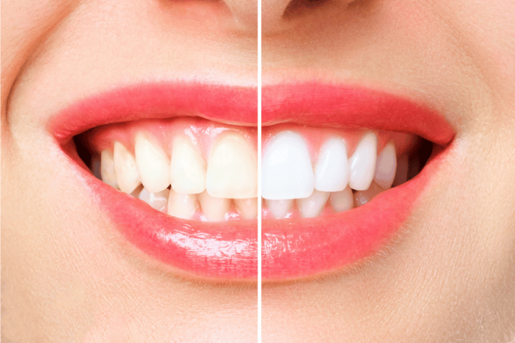 The Science Behind Teeth Whitening: How Does it Work?