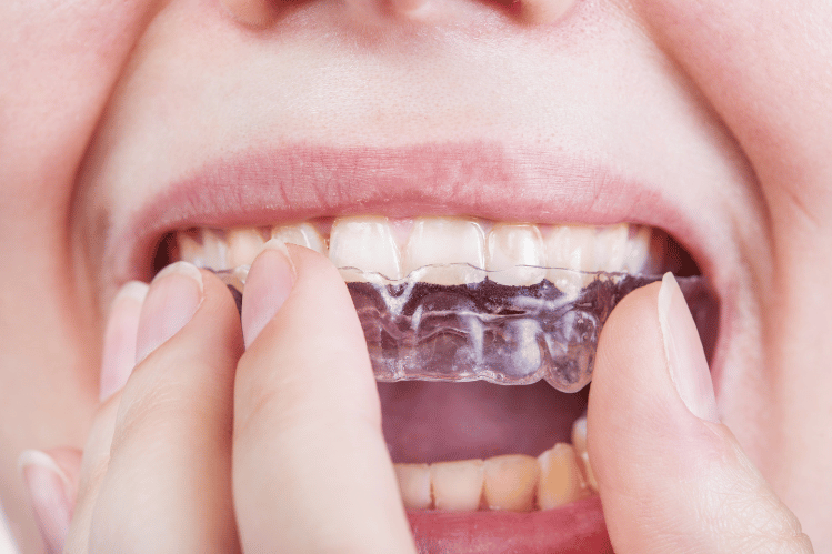 Common Misconceptions About Invisible Aligners