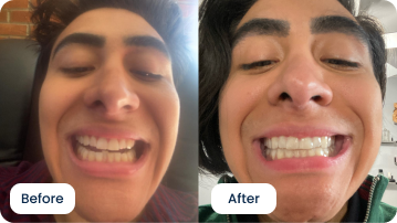 Alexander Kiessling’s 6-Month Smile Transformation with ALIGNERCO