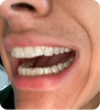 Alexander Kiessling’s 6-Month Smile Transformation with ALIGNERCO