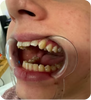 Matt Upton Thanks ALIGNERCO for an Easy Teeth Straightening Journey