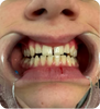 Matt Upton Thanks ALIGNERCO for an Easy Teeth Straightening Journey