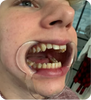 Matt Upton Thanks ALIGNERCO for an Easy Teeth Straightening Journey